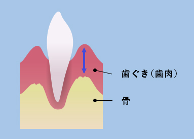 歯茎のイラスト1