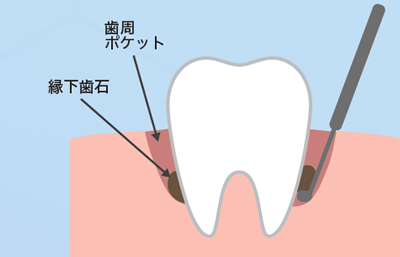 SRP治療