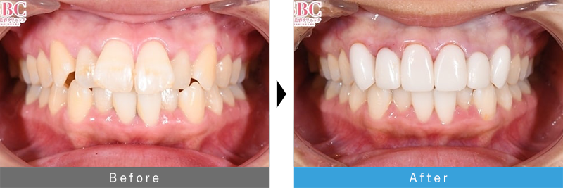 フルジルコニアセラミック 6本セット 症例1 before after