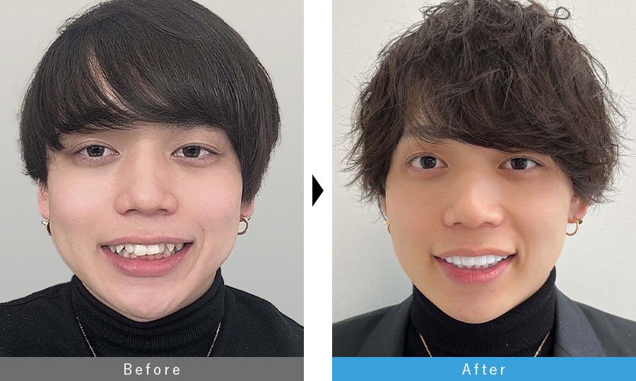 ガタつき改善 before after