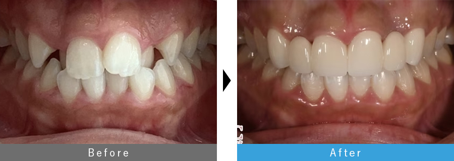 出っ歯×ガタつき改善 before after