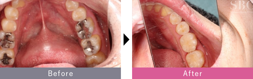 セラミックインレーの症例写真