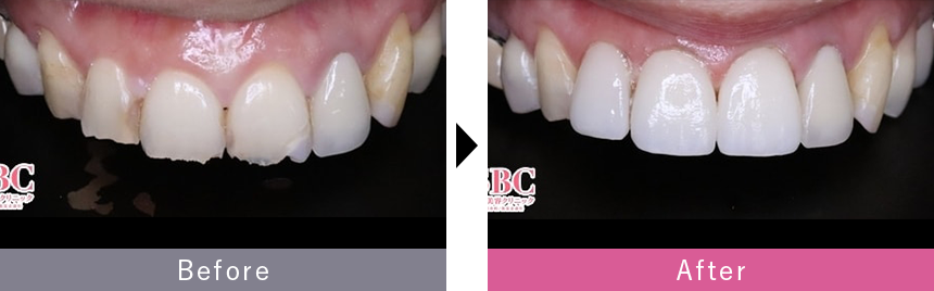 ラミネートべニアの症例写真