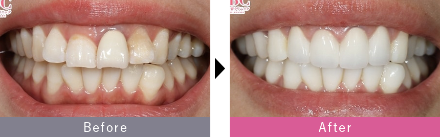 セラミック矯正の症例写真