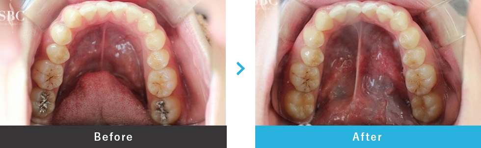 コンポジットレジン