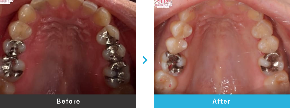 セラミックインレー