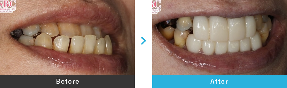 ダイヤモンドクラウン（ジルコニア）