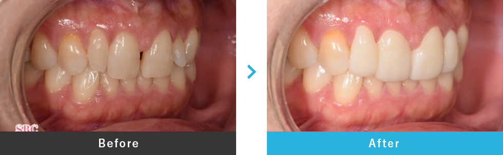 ダイヤモンドべニア