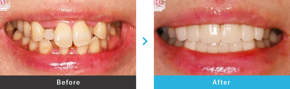 プレミアムダイヤモンドセラミック