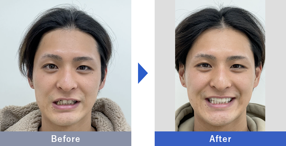 ダイヤモンドオーダーセラミックの症例写真 Before After