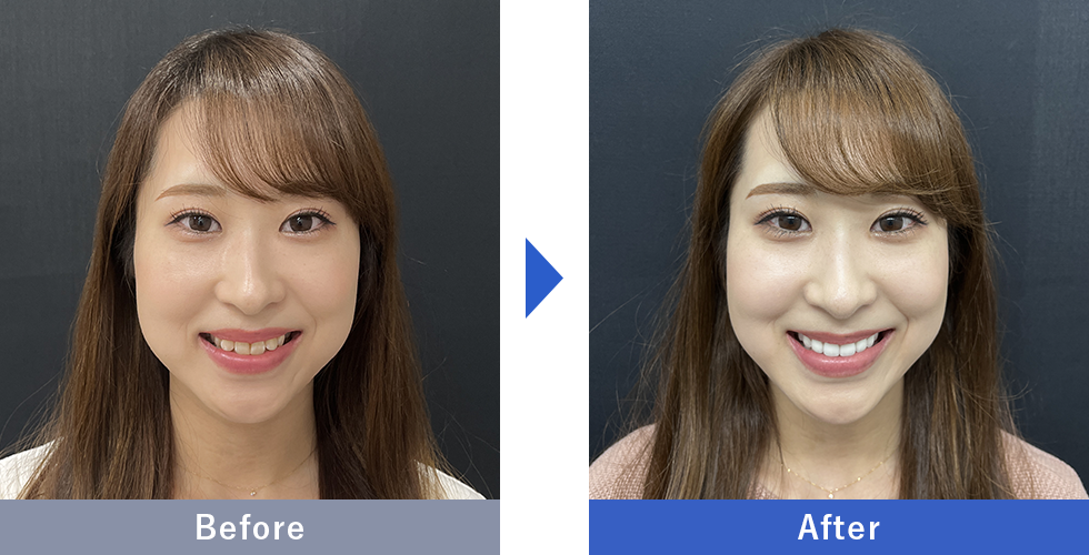 ダイヤモンドオーダーセラミックの症例写真 Before After