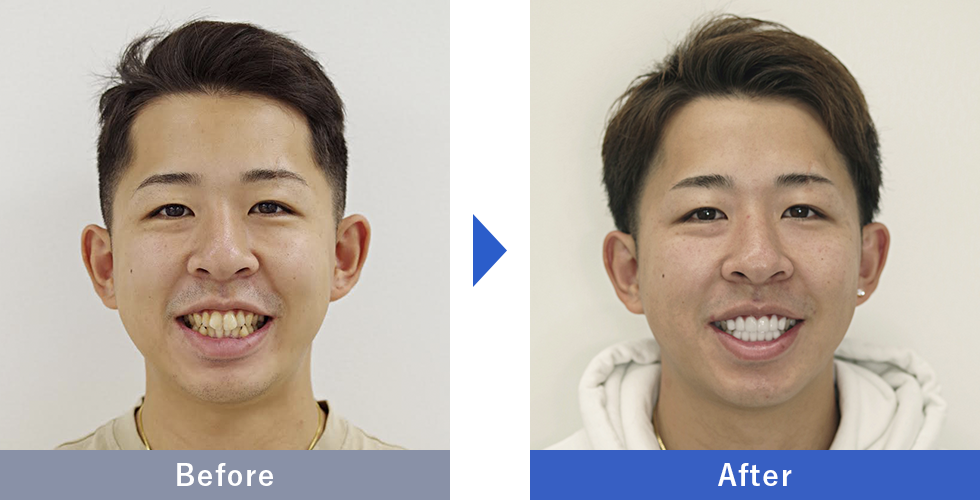 ダイヤモンドオーダーセラミックの症例写真 Before After