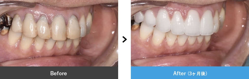 セラミック 症例写真