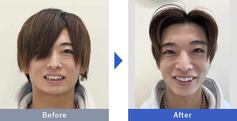 プレミアムダイヤモンドセラミックの症例写真 Before After