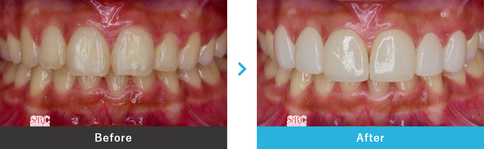 ラミネートべニアの症例写真 before after