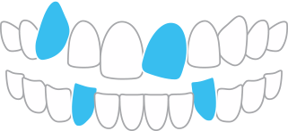 ガタガタした歯並びや八重歯（叢生）