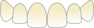 歯の黄ばみ