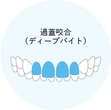 過蓋咬合のイメージイラスト