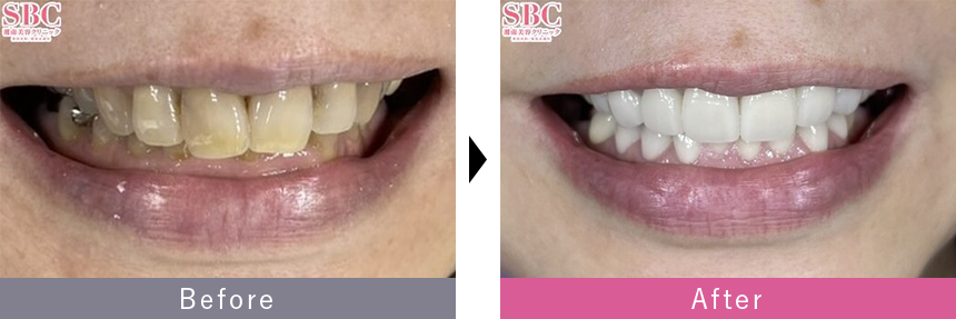 プレミアムダイヤモンドセラミックの症例写真