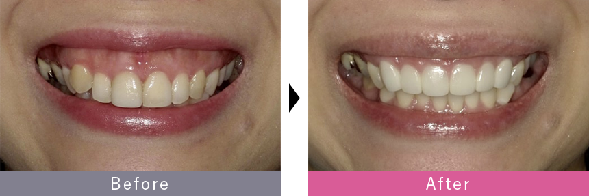 プレミアムダイヤモンドセラミックの症例写真