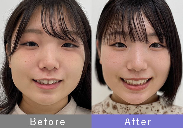 before after