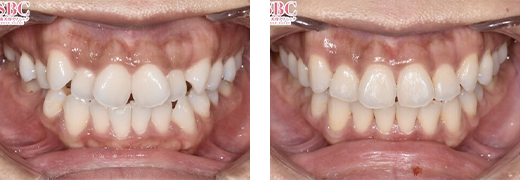 八重歯の症例写真②