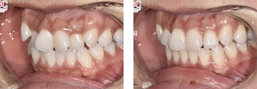 八重歯の症例写真③