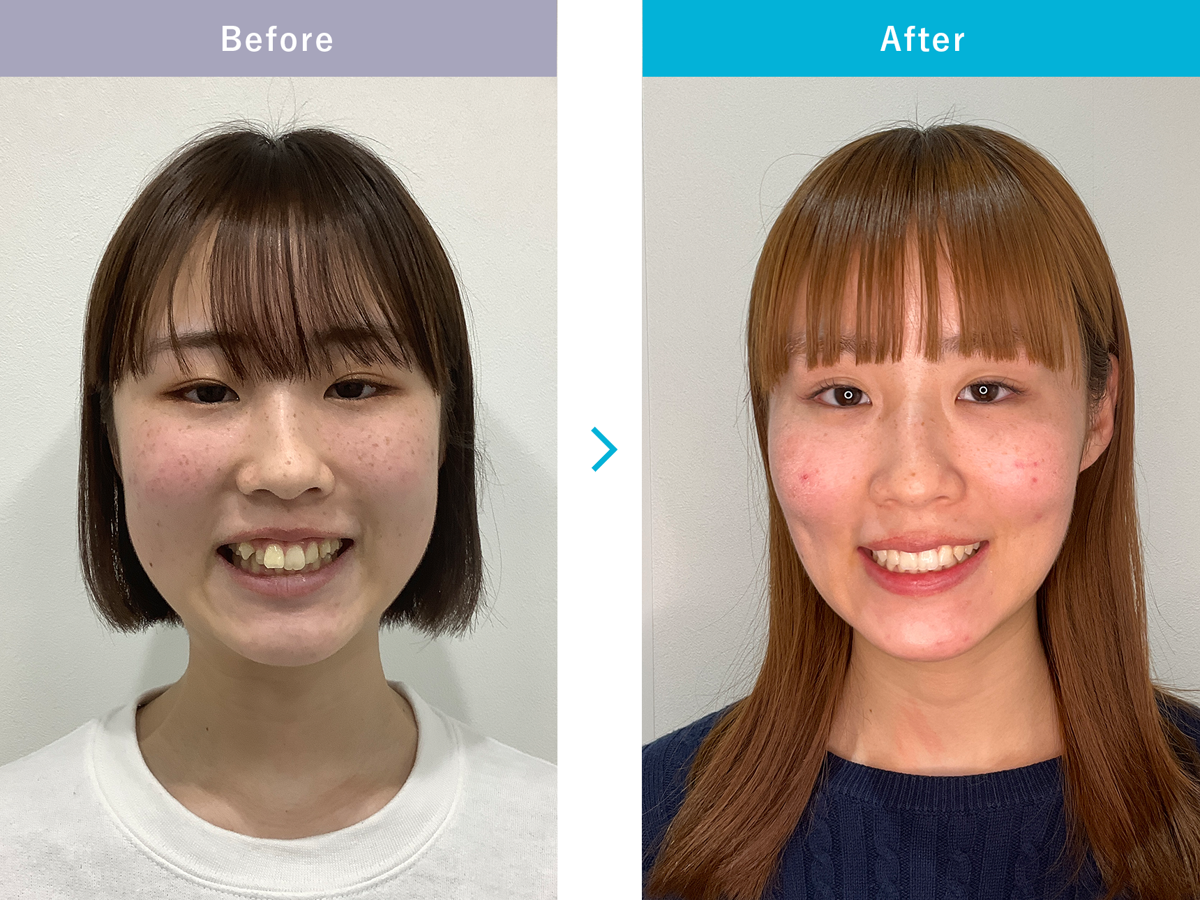 インビザラインGoの症例写真