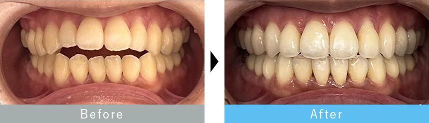 インビザライン
