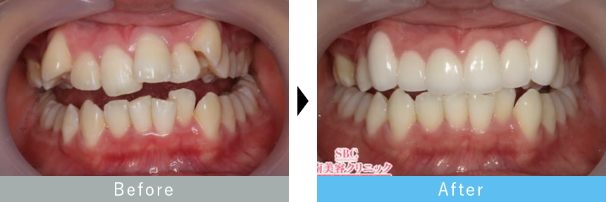 プレミアムダイヤモンドセラミック