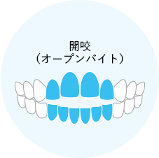 八重歯（叢生・乱ぐい歯）とは？