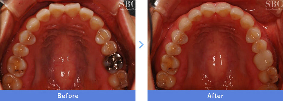 セラミックインレーの症例写真2