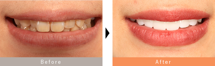 出っ歯のセラミック治療の症例