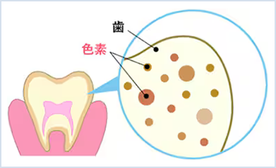 歯の色素