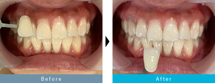 出っ歯のマウスピース矯正の症例